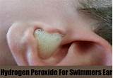 Photos of Swimmers Ear Infection Treatment