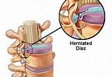 Herniated Disc Treatment Non Surgical