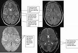 Anoxic Brain Damage Recovery Pictures