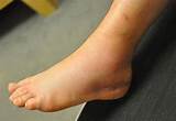 Pictures of Exercise Routine Sprained Ankle