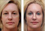 Images of Parotid Gland Removal Recovery Time