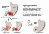 Acute Gastritis Home Remedies Images