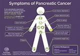 Current Treatment For Pancreatic Cancer Images