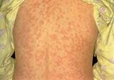 Measles Pneumonia Treatment Pictures