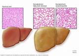 Pictures of What Is Fatty Liver Mayo Clinic
