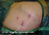 Kidney Stone Removal Recovery Pictures