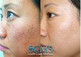 Acne Scar Laser Treatment Uk Photos