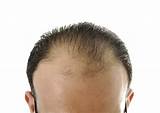 Hair Thinning Treatment Male