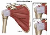 Rotator Cuff Therapy Protocol Pictures