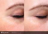 Laser Treatment For Fine Lines Images