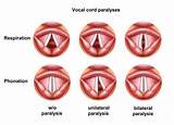 Fast Breathing Medical Term