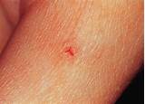 Images of Leech Therapy For Wounds