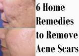 Photos of Ayurvedic Treatment For Acne Scars