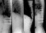 Images of T12 Fracture Recovery