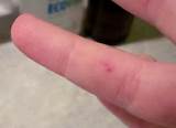 Pictures of Wasp Sting Remedy
