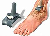 Ankle Replacement Recovery Time Images