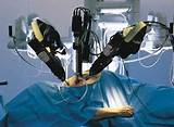 Robotic Assisted Myomectomy