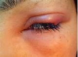 Upper Eyelid Infection Home Remedies Photos