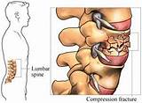 Compression Fracture Treatment Physical Therapy Pictures