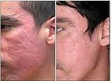 Acne Scar Laser Treatment Uk Pictures