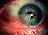 Photos of Can Eye Doctors See Floaters