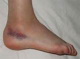 Images of Ice Or Heat For Deep Bruise