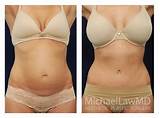 Images of Recovery After Tummy Tuck And Lipo