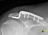 Images of Distal Clavicle Fracture Treatment