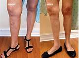 Varicose Veins Laser Treatment Prices Images