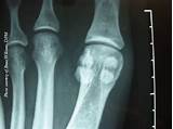 Pictures of Tibial Sesamoid Fracture Treatment