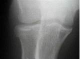 Pictures of Occult Fracture Elbow Treatment