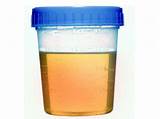 Photos of What Medications Can Cause Protein In Urine