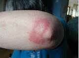 Eczema In Elbow Crease Treatment Photos
