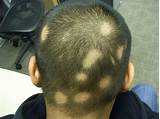Photos of Can Hair Grow Back After Alopecia