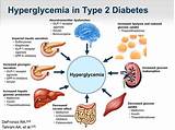 Images of Treatment For Hyperglycemia In Type 2 Diabetes