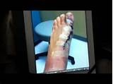 Ankle Ligament Surgery Brostrom Recovery Time Pictures