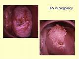 Images of Cervical Cancer During Pregnancy Treatment