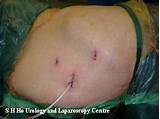 Laparoscopic Kidney Surgery Recovery Time