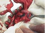 Pictures of Colorectal Fistula Treatment