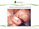 Endometriosis Fertility Treatment Options Photos
