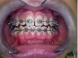 Orthodontic Treatment Photos Images