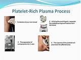 Platelet Rich Plasma Treatment For Low Back Pain