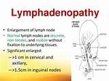 Lymphadenopathy Medical Definition Pictures