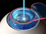 The Risk Of Lasik Eye Surgery Images