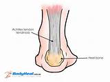 What Is The Recovery Time For A Torn Achilles Tendon Pictures