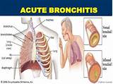 What Is The Medical Treatment For Bronchitis Photos