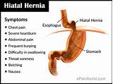 Photos of Hiatal Hernia Diagnosis And Treatment