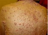 Multiple Neurofibromatosis Treatment Images