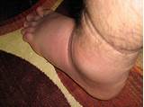 Sprained Ankle Fast Recovery Pictures
