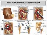 Partial Hip Replacement Recovery Time Elderly Images